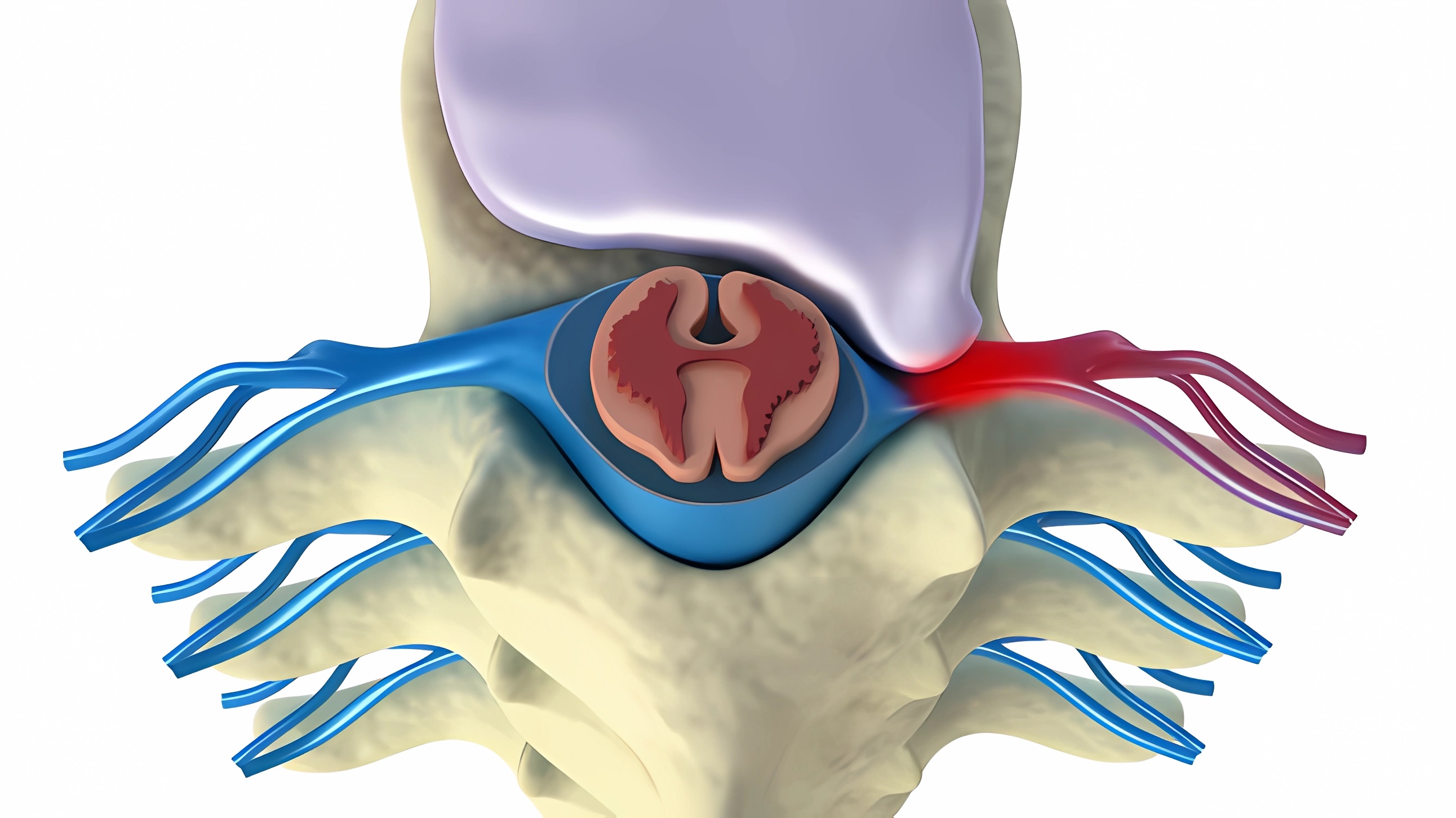 Cu L Es El Mejor Tratamiento Para Las Hernias Discales Onda Vasca