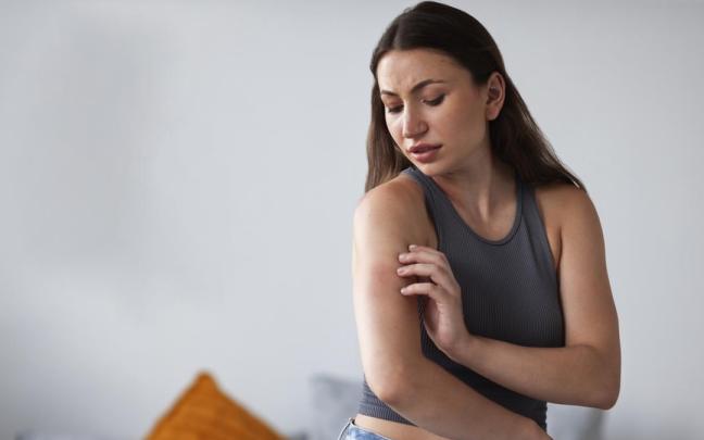 Una joven después de sufrir una picadura de mosquito