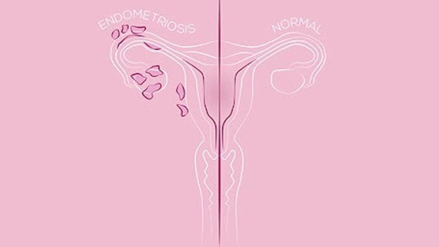 La endometriosis es el crecimiento anormal de tejido similar al endometrio fuera del útero.