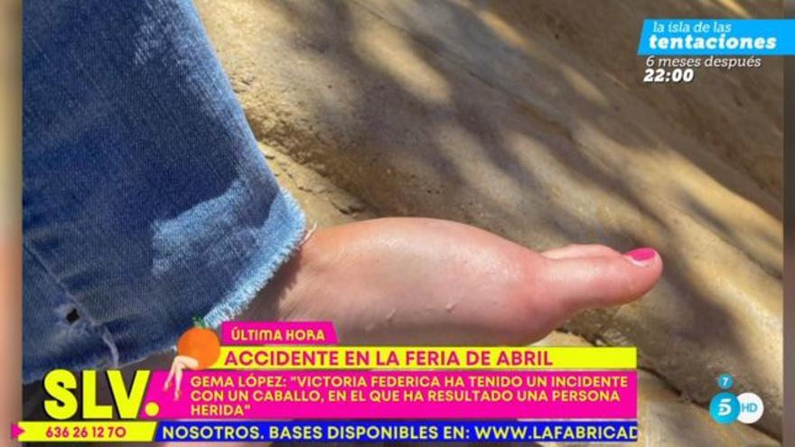El pie de la víctima, tras el pisotón del caballo.