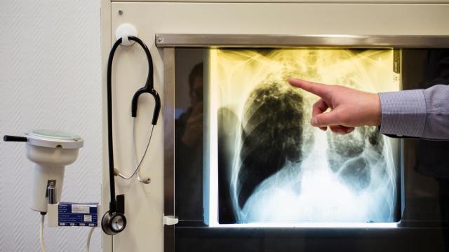 Un doctor muestra signos de tuberculosis en una radiografía.
