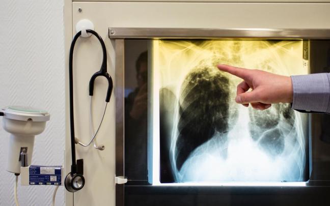 Un doctor muestra signos de tuberculosis en una radiografía.