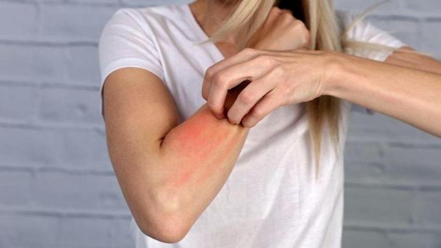 El picor intenso es un síntoma inequívoco de la sarna causada por un ácaro que se llama Sarcoptes scabiei, que solo sabe vivir en la piel del humano.