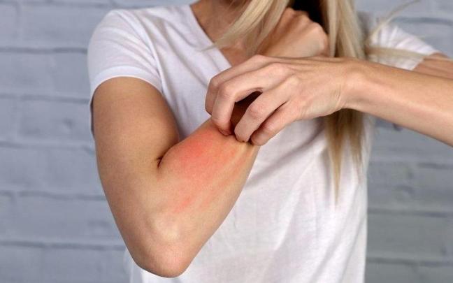 El picor intenso es un síntoma inequívoco de la sarna causada por un ácaro que se llama Sarcoptes scabiei, que solo sabe vivir en la piel del humano.