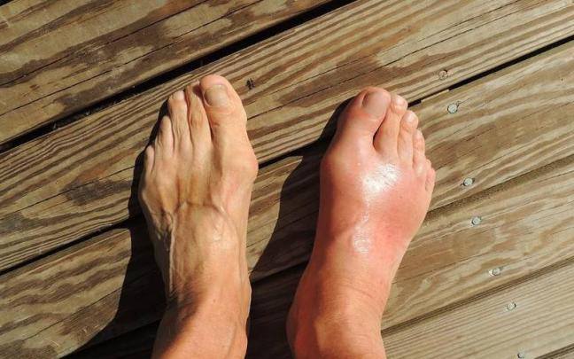 La &uacute;lcera en el pie es una de las complicaciones frecuentes en las personas con diabetes.