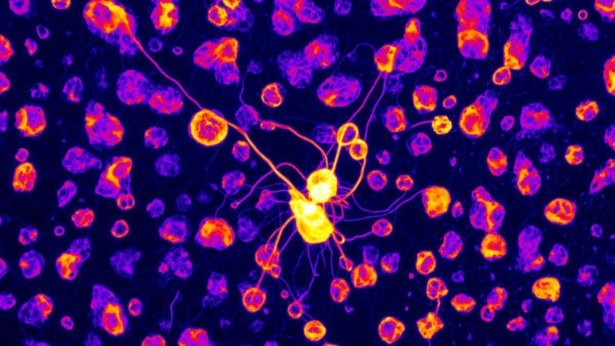 Una investigación biomédica revela el papel crucial de unos genes en el autismo idiopático.