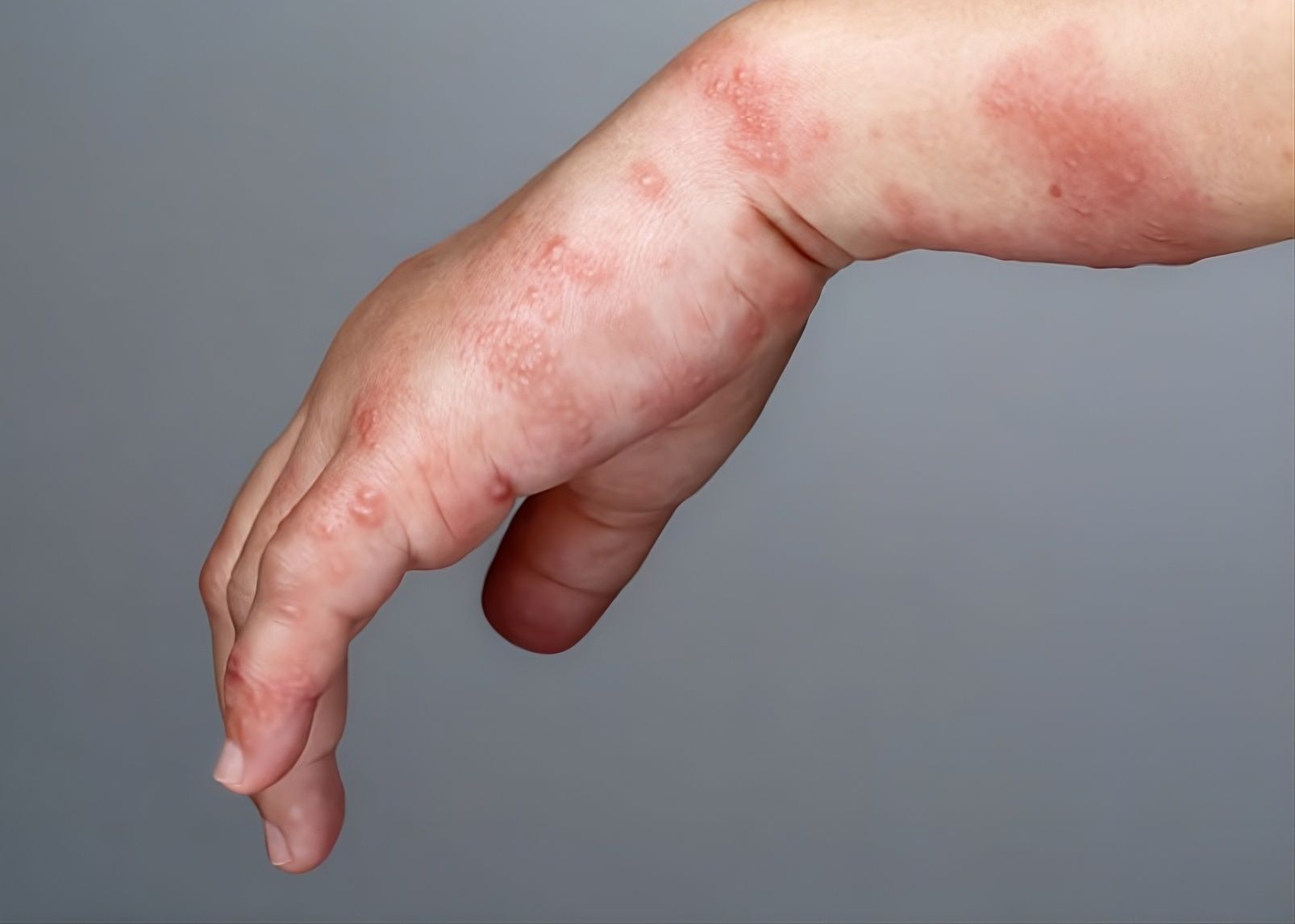 Síntomas de herpes zóster en el brazo.