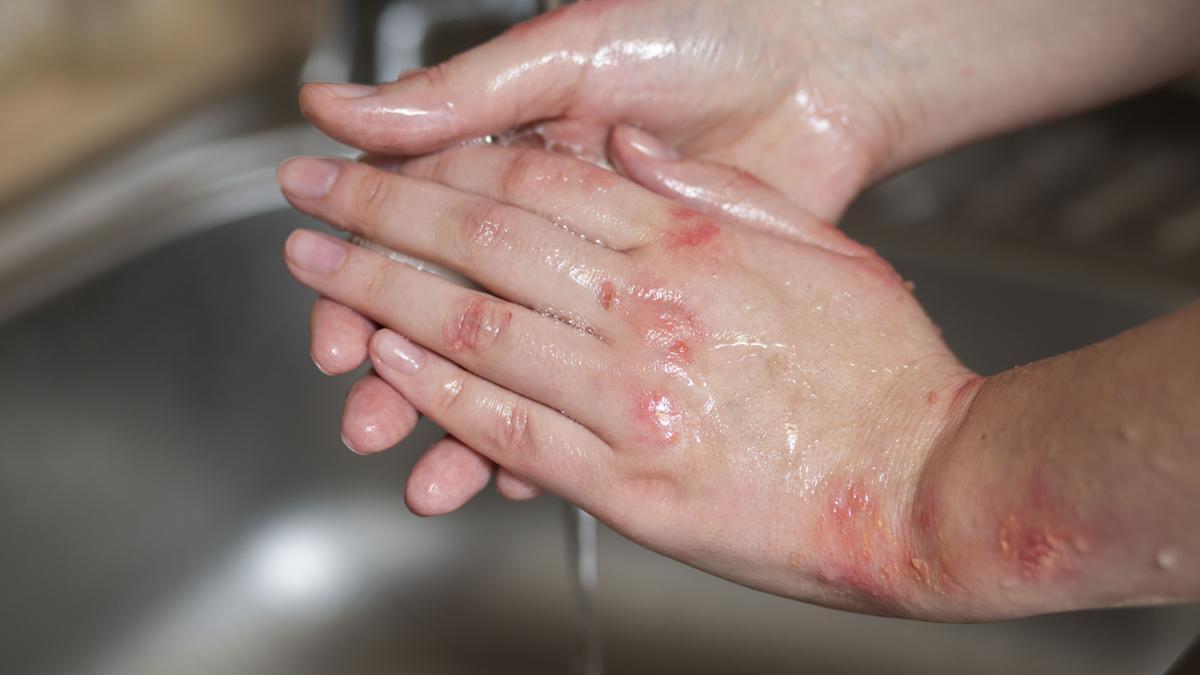La psoriasis puede implicar problemas cardiovasculares y reumatológicos.