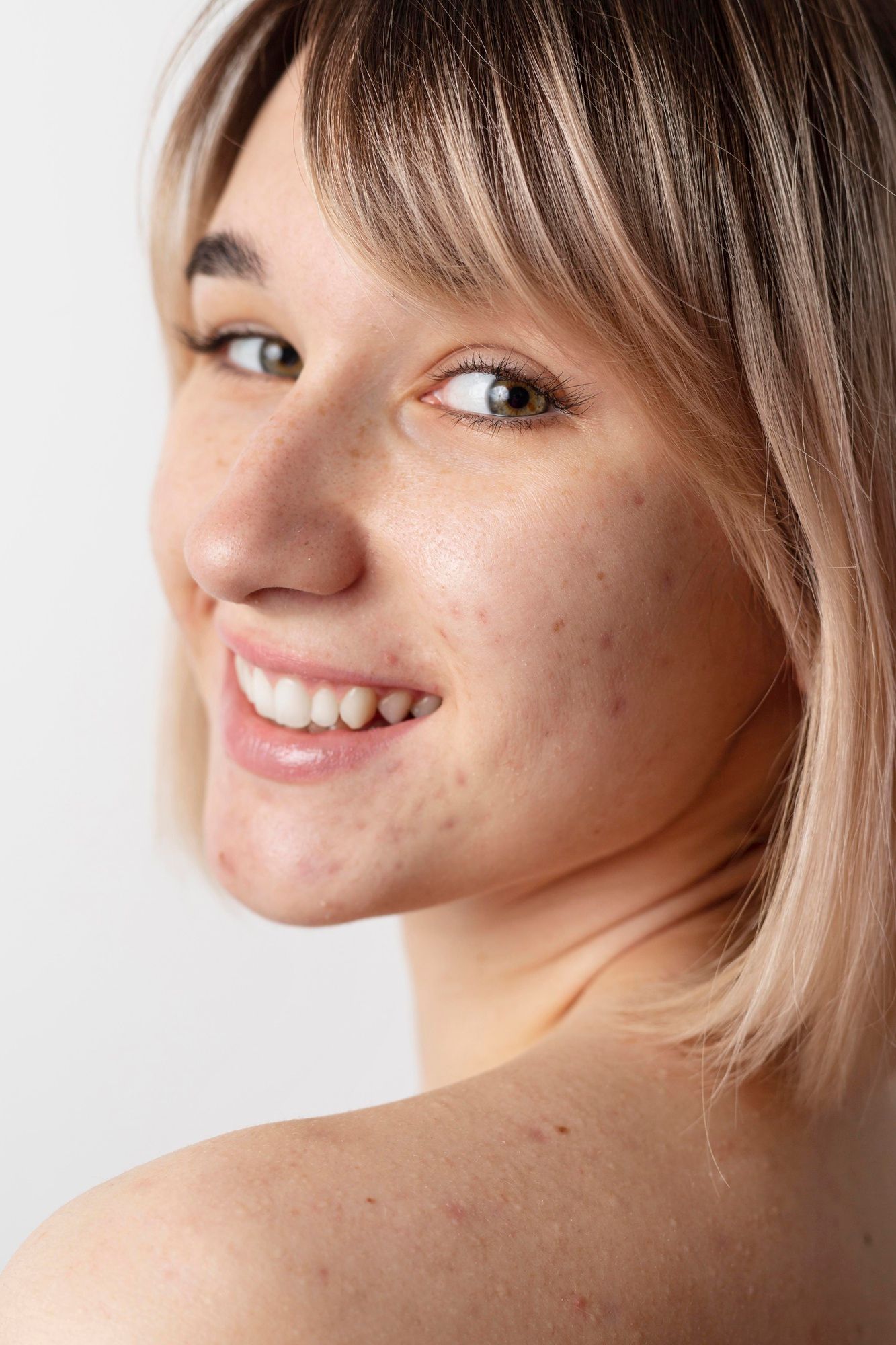 Una mujer con acné posa sonriente.