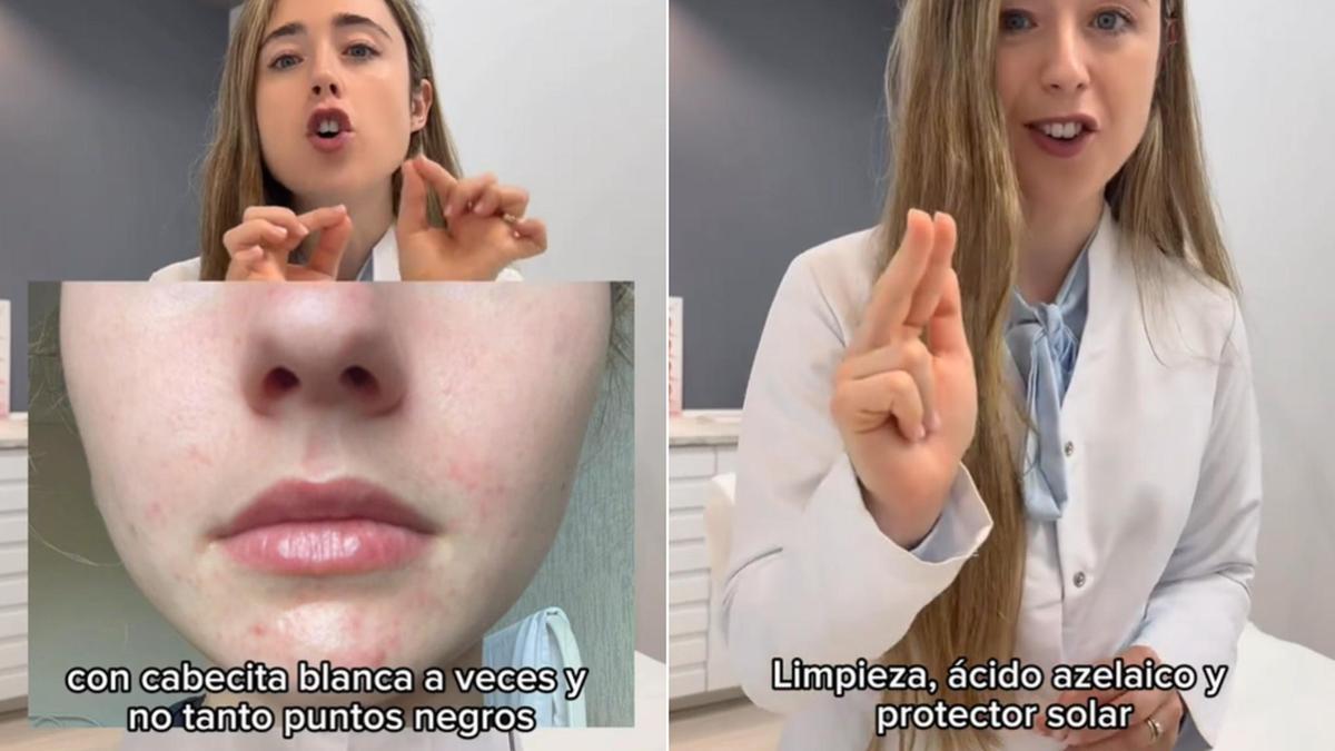 La dermatóloga recomienda seguir una rutina muy sencilla de tres pasos para acabar con este trastorno.