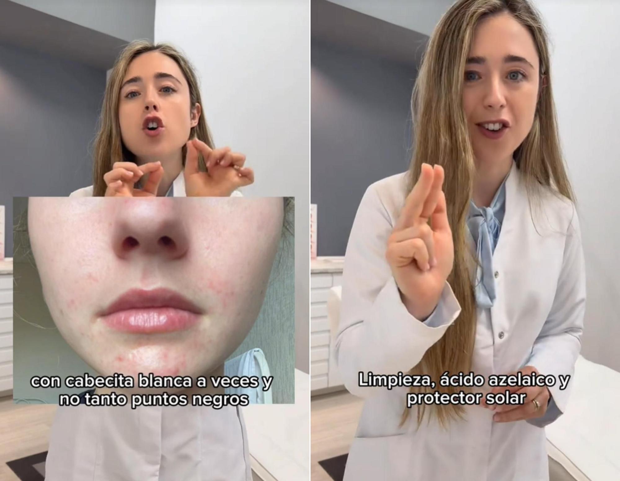 La dermatóloga recomienda seguir una rutina muy sencilla de tres pasos para acabar con este trastorno.