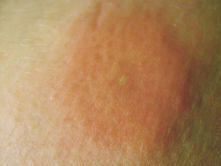 Picadura de abeja.