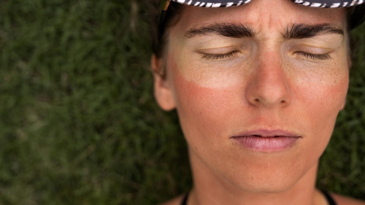 Una persona con la cara quemada por el sol.