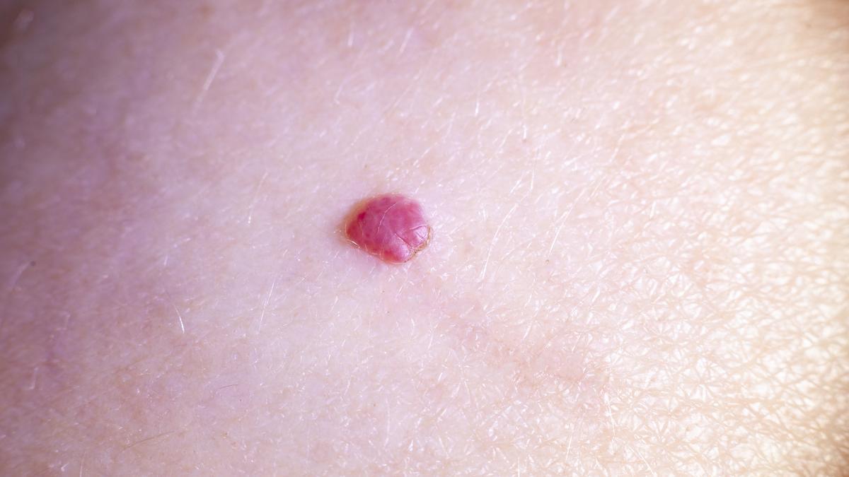 El hemangioma es un tumor vascular no cancerígeno que tiene una alta incidencia en bebés.