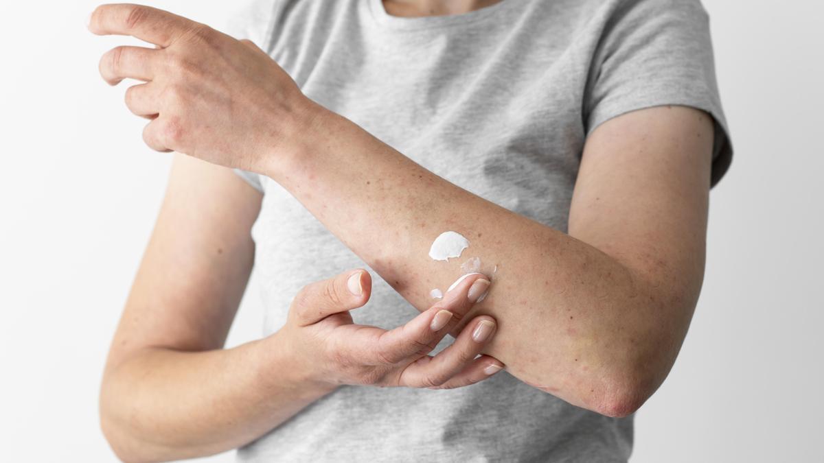 En muchas ocasiones la dermatitis atópica tiene su debut clínico siendo bebé.