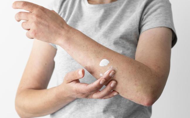 En muchas ocasiones la dermatitis atópica tiene su debut clínico siendo bebé.