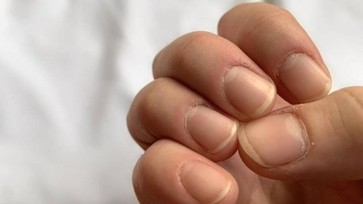 Las uñas sanas suelen tener un color rosado uniforme, una superficie lisa, sin grietas, manchas ni deformidades