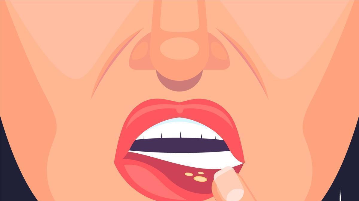 El síndrome de Behçet produce lesiones características en la piel y en las mucosas.