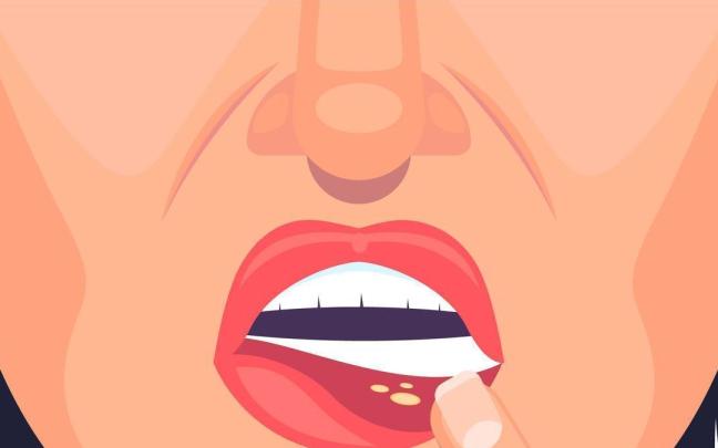 El síndrome de Behçet produce lesiones características en la piel y en las mucosas.