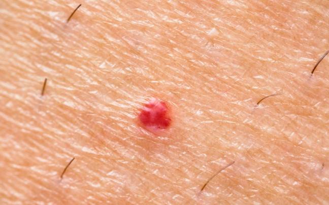 Un punto rubí en un fragmento de piel de una persona.