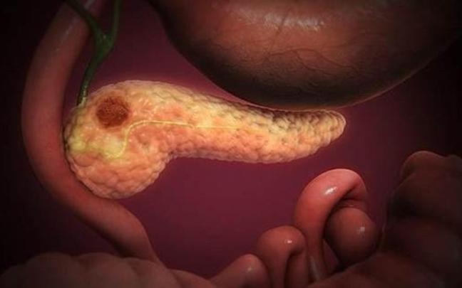 Cáncer de páncreas