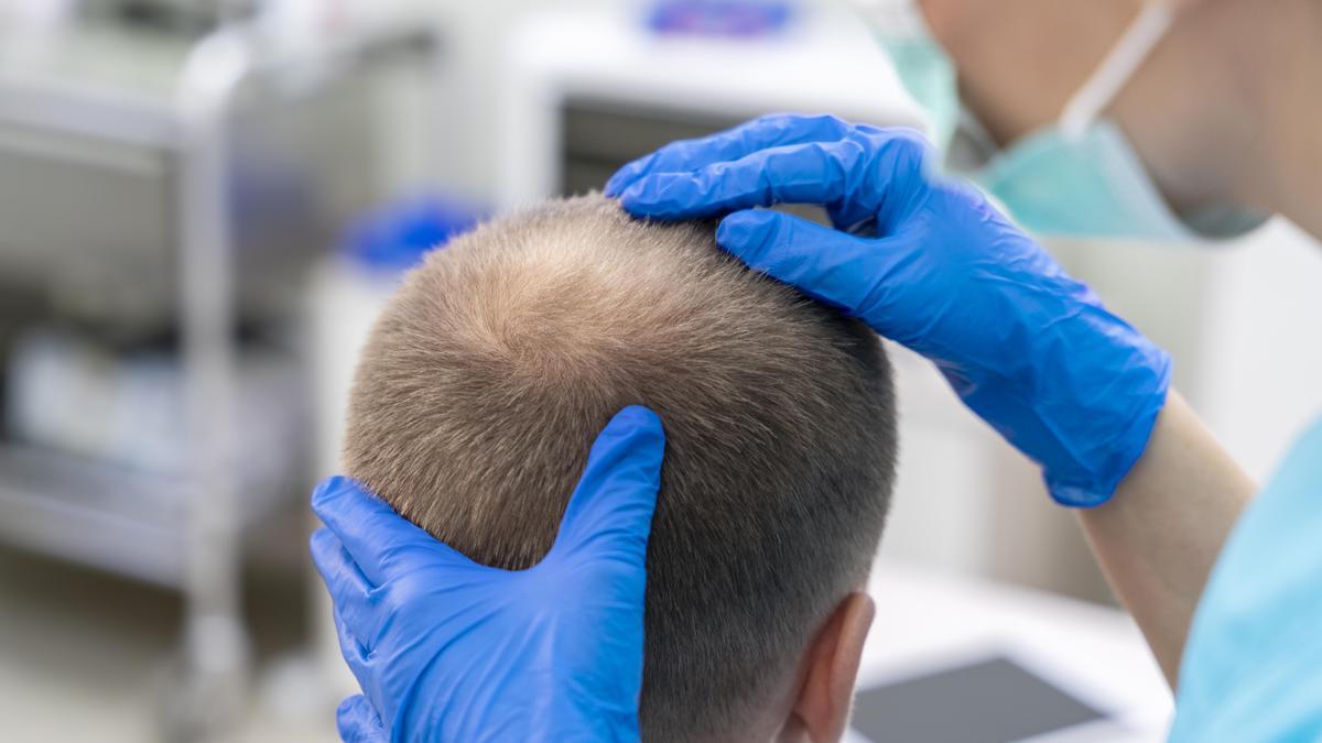 El injerto capilar no frena la alopecia, mejora la densidad.