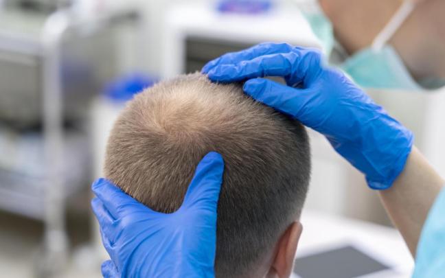 El injerto capilar no frena la alopecia, mejora la densidad.