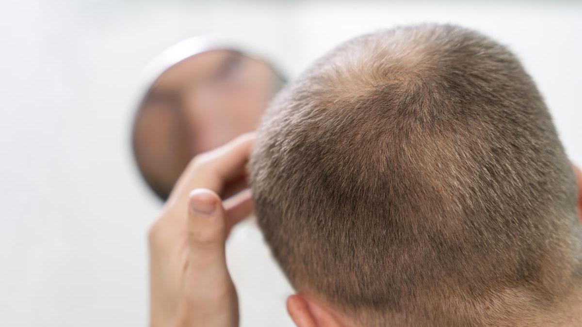 La finasterida se utiliza para tratar las primeras etapas de la alopecia androgénica.