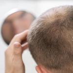 La finasterida se utiliza para tratar las primeras etapas de la alopecia androgénica.