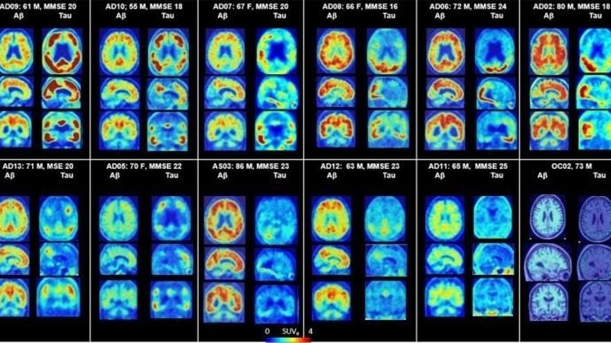PET del cerebro que muestra placas amiloides y proteínas tau en Alzheimer.