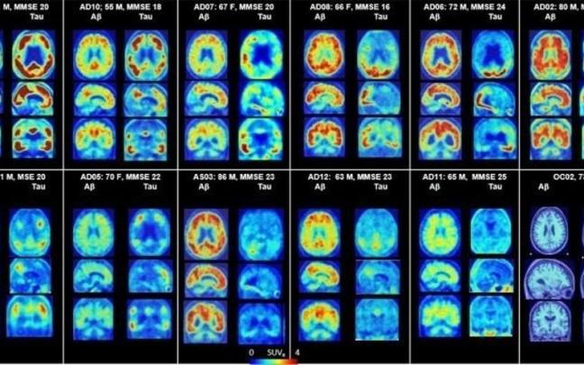 PET del cerebro que muestra placas amiloides y proteínas tau en Alzheimer. PET del cerebro que muestra placas amiloides y proteínas tau en Alzheimer.