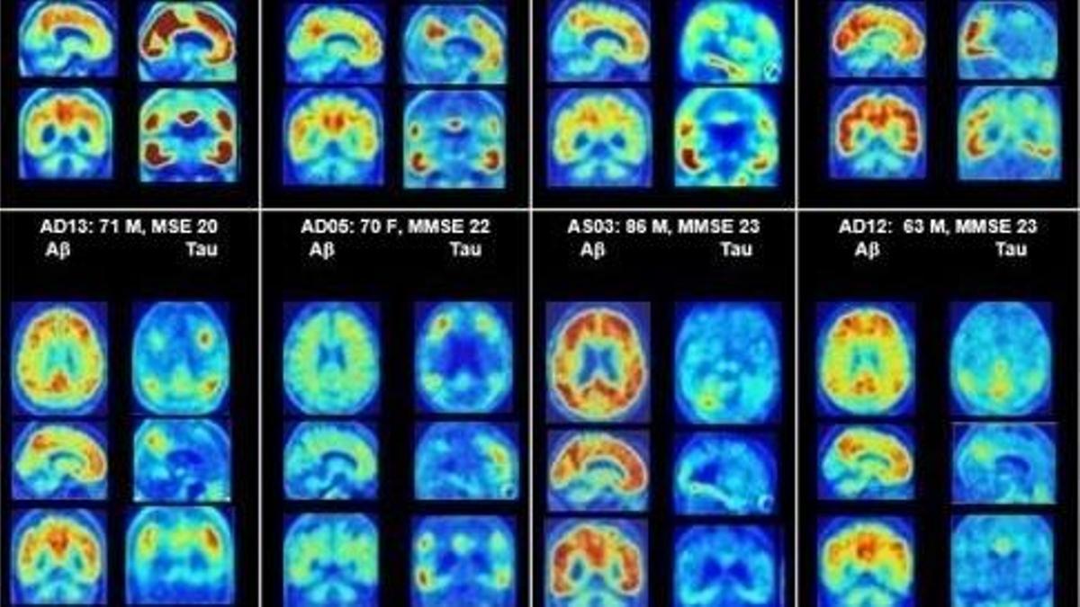 PET del cerebro que muestra placas amiloides y proteínas tau en Alzheimer.