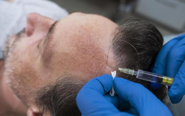Un hombre se somete a un tratamiento de injerto capilar.