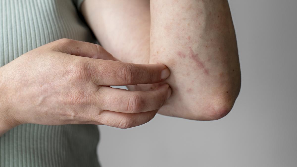 Reacción alérgica cutánea en el brazo.
