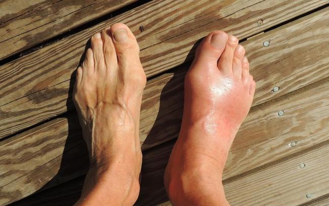 Para sufrir un ataque de gota, influyen factores como la hidratación corporal, el estrés o el uso de medicamentos.