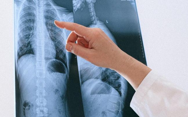 Radiografía de pulmón.