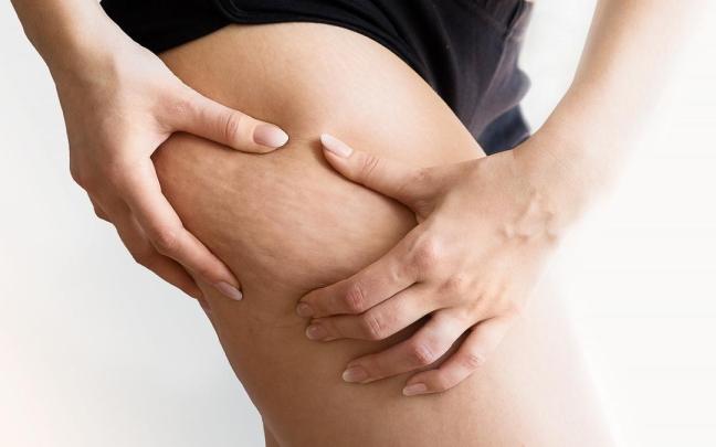 Una mujer muestra con sus manos la piel de naranja. Una mujer muestra con sus manos la piel de naranja.