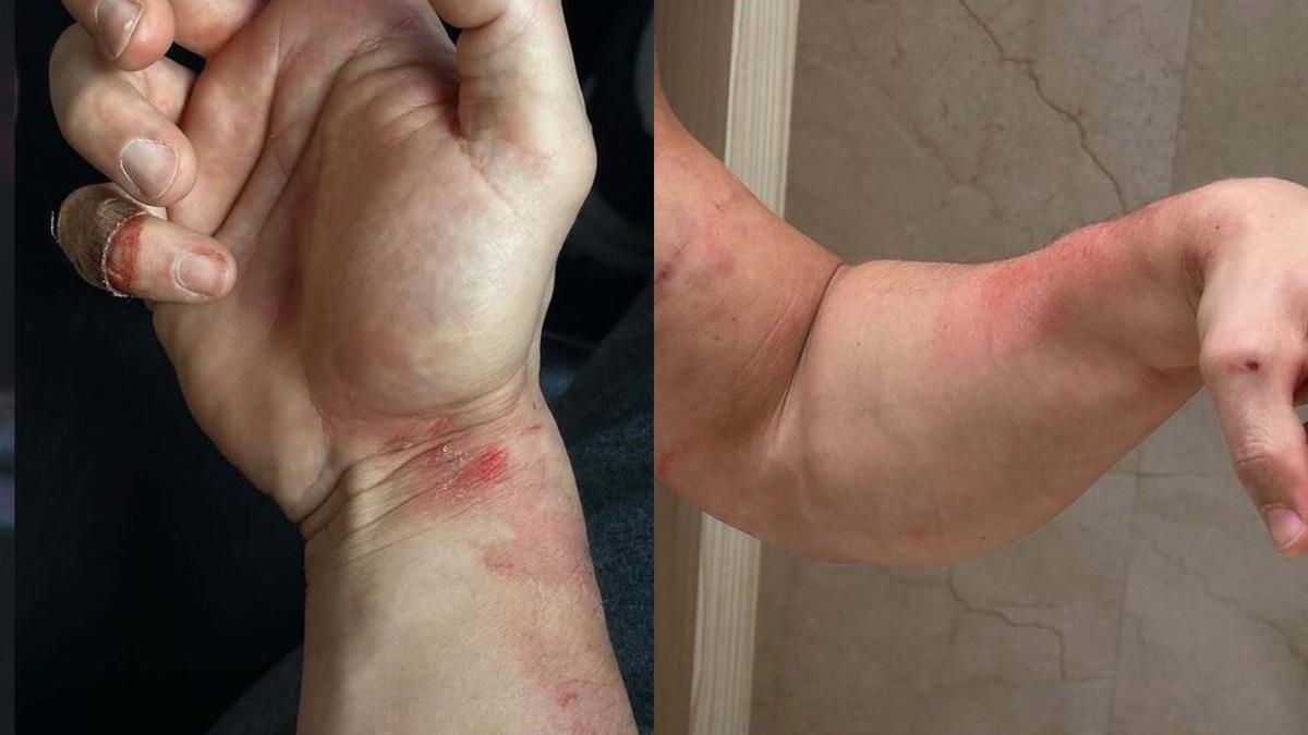 Gotzon Mantuliz muestra sus heridas en una publicación de Instagram