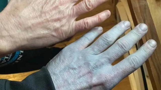 La mano azulada del hombre, junto a la de su amigo.