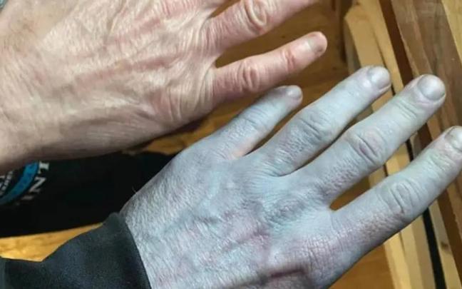 La mano azulada del hombre, junto a la de su amigo.