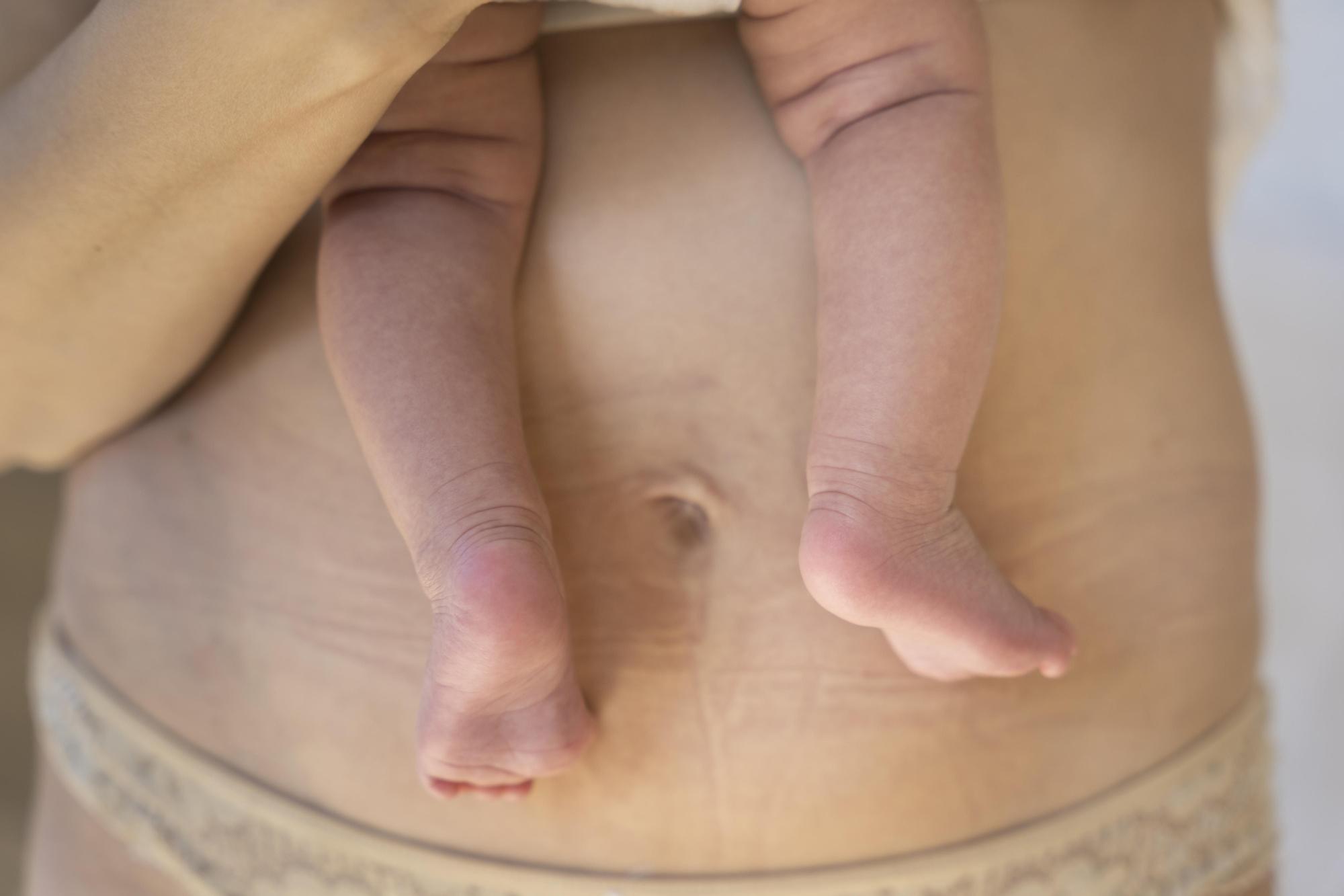 Abdomen postparto de una mujer con su bebé recién nacido en brazos.