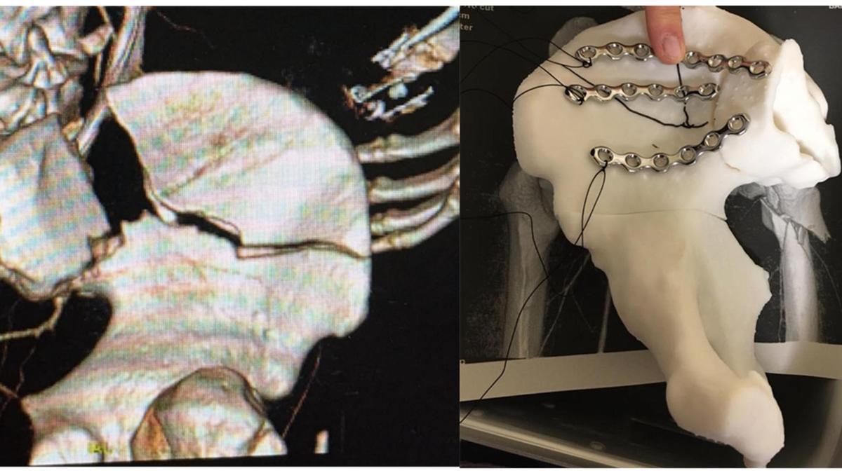 Modelo de pelvis impreso en 3D que permite moldear y preparar las placas antes de la intervención.