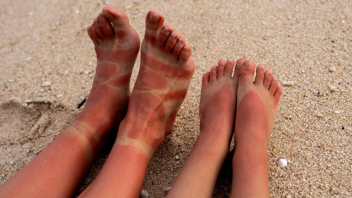 Unos pies quemados por el sol muestra las marcas dejadas por las tiras de las sandalias.