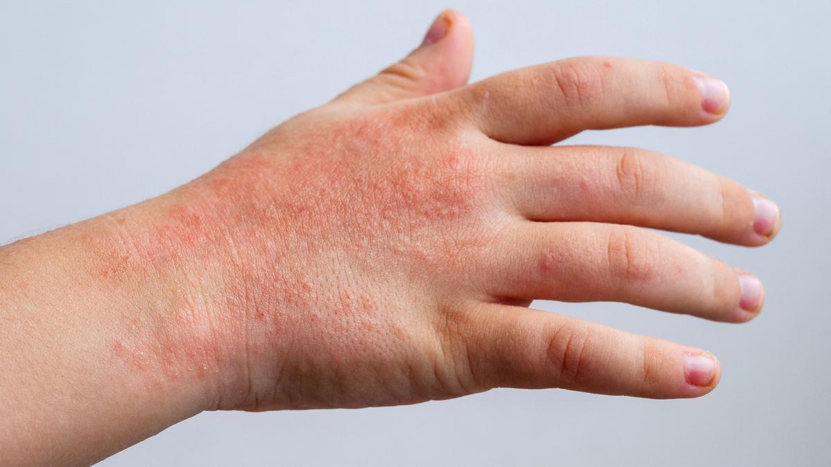 Mantener la piel hidratada es clave para prevenir los eccemas.