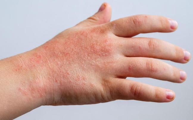 Mantener la piel hidratada es clave para prevenir los eccemas.