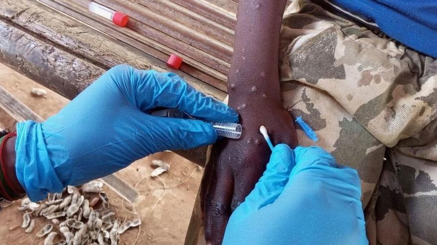 Un trabajador sanitario toma una muestra de una persona con mpox.