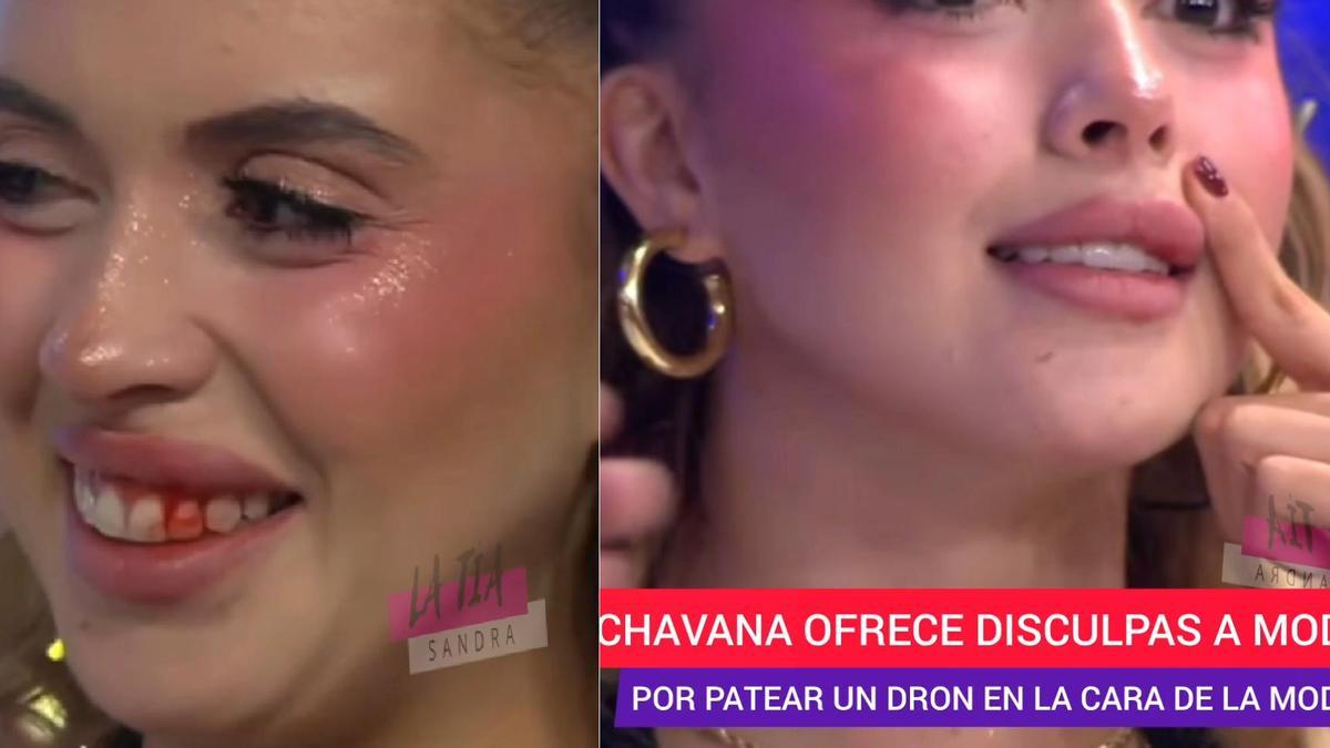 La modelo sufrió un corte profundo en el labio superior.