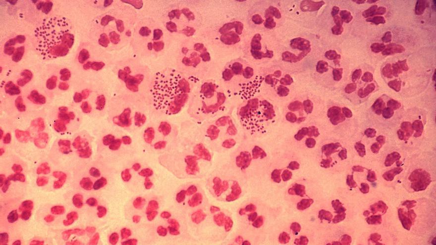 Microfotografia caso agudo uretritis gonococica