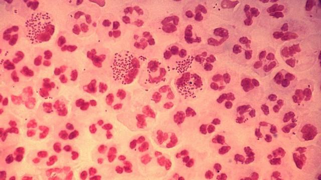 Microfotografia caso agudo uretritis gonococica