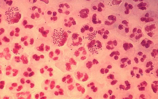 Microfotografia caso agudo uretritis gonococica